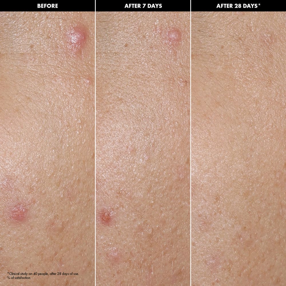 CLEAR SKIN SERUM (S&Eacute;RUM ANTIIMPERFECCIONES CON &Aacute;CIDO MAND&Eacute;LICO + PREBI&Oacute;TICOS)